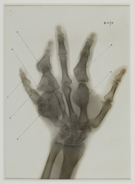 Hand with bone deformations (2008-323)